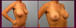Breast Lift in Fort Myers