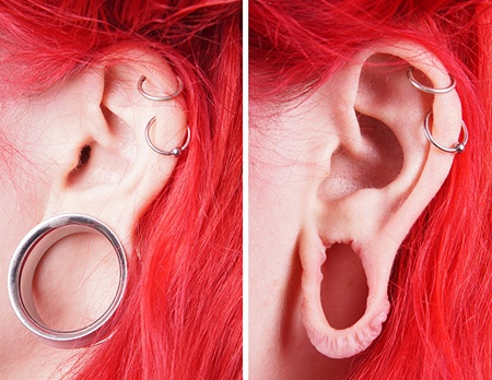 A photo fo stretched earlobe / gauging repair