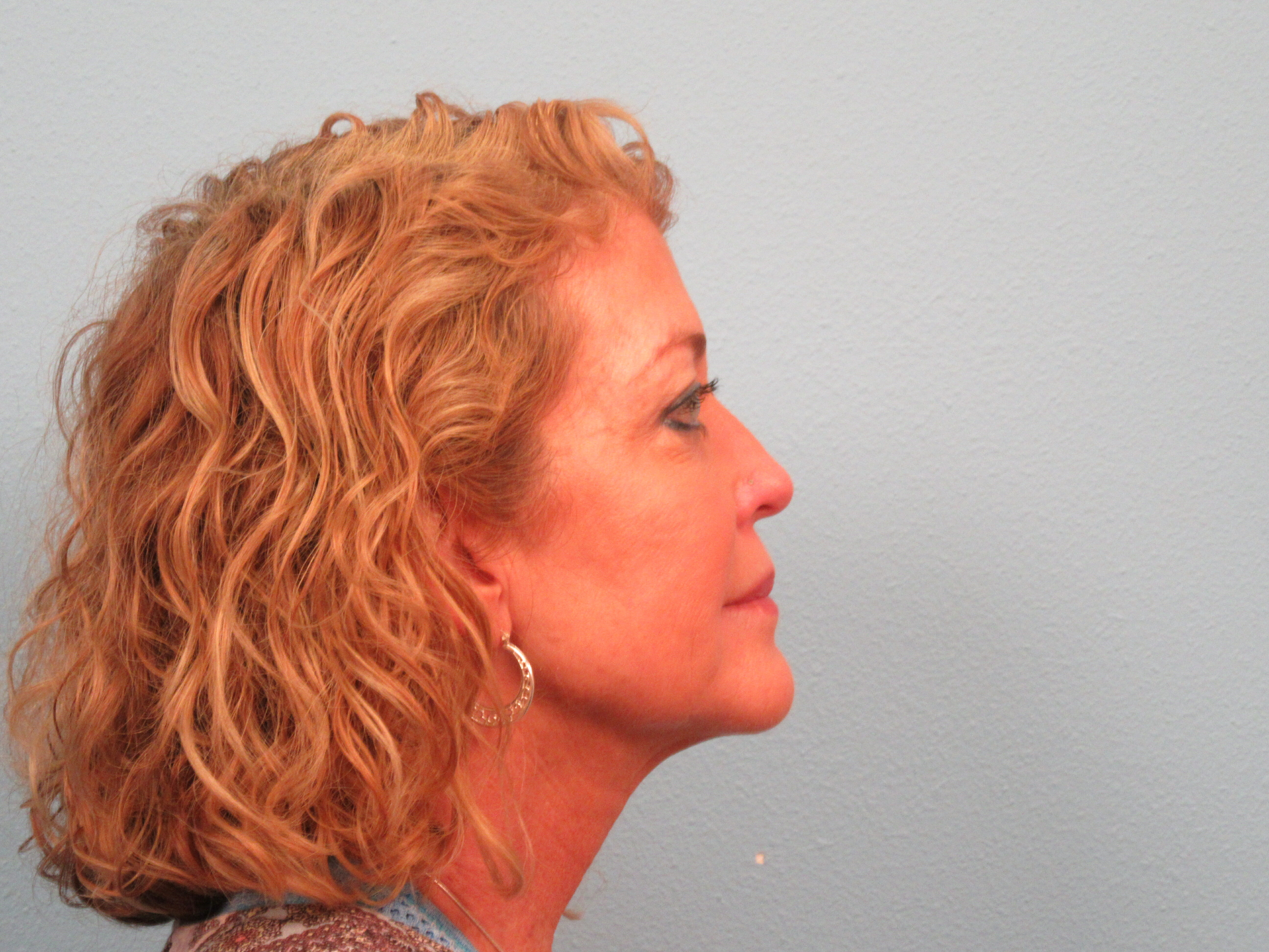 After instant neck lift