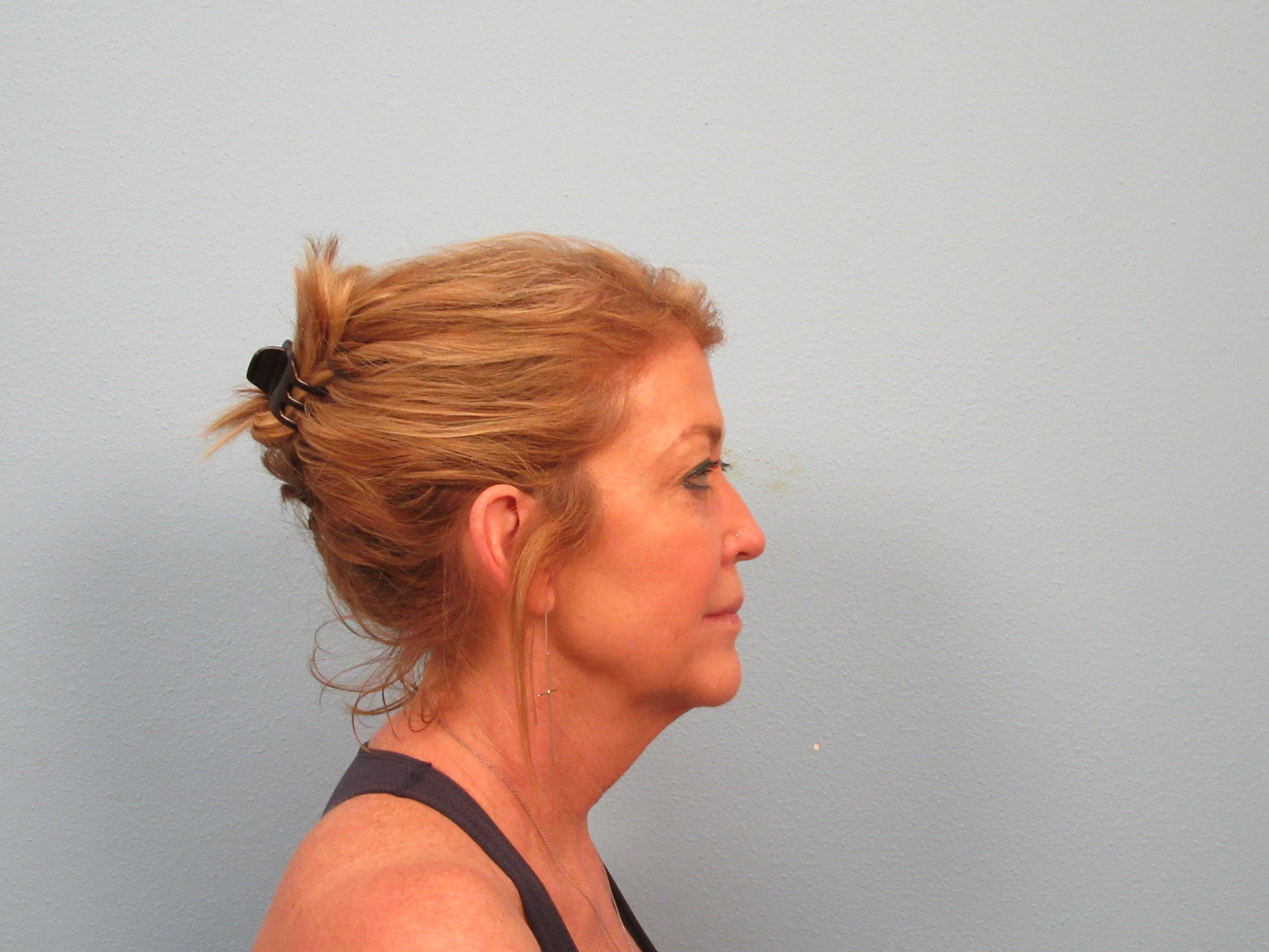 Before instant neck lift