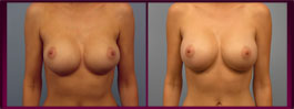 Fort Myers Breast Lift Images