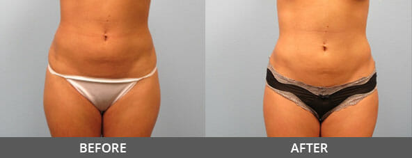 Body Contouring Before and After