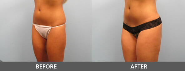 Body Contouring Before and After