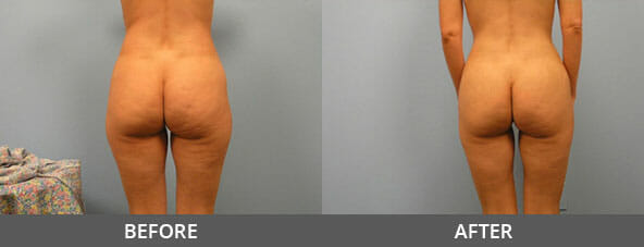 Body Contouring Before and After