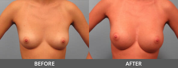 Breast Augmentation Before and After