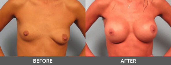 Breast Augmentation Before and After