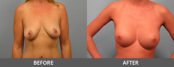 Breast Augmentation Before and After
