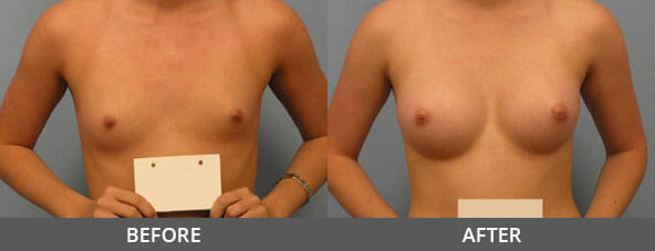 Breast Augmentation Before and After