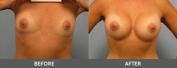 Breast Augmentation Before and After