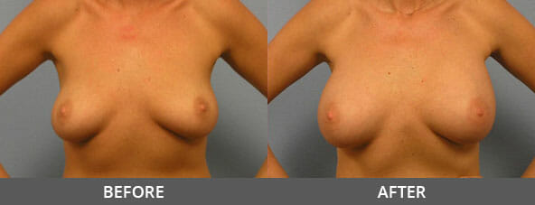 Breast Augmentation Before and After