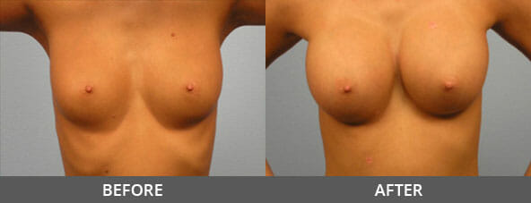 Breast Augmentation Before and After