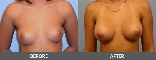 Breast Augmentation Before and After