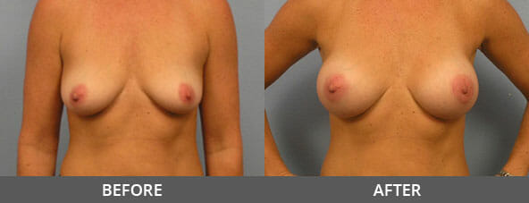 Breast Augmentation Before and After