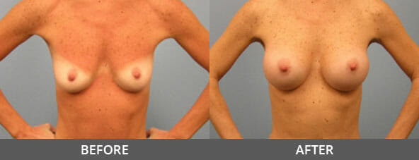 Breast Augmentation Before and After