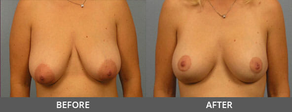 Breast Lift Before and After