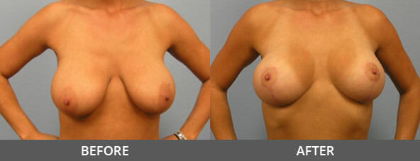 Breast Lift Before and After