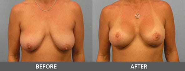 Breast Lift Before and After