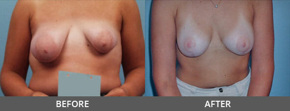 Breast Lift Before and After