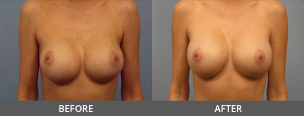 Breast Lift Before and After