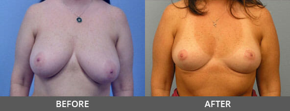 Breast Reduction Before and After