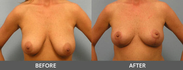 Breast Reduction Before and After