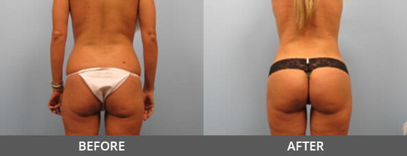Butt Lift Before and After
