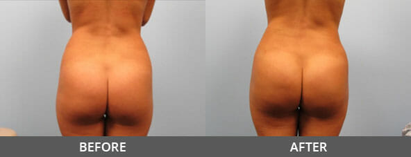 Butt Lift Before and After