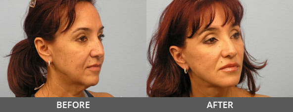 Facelift Before and After