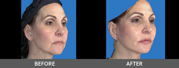 Facelift Before and After