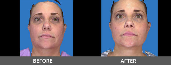 Facelift Before and After