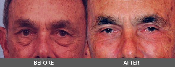 Facelift Before and After