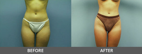 Liposuction Before and After