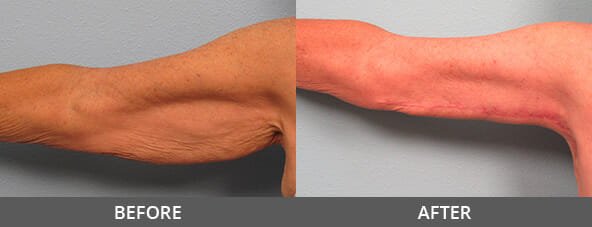 Before and After Arm Lift Naples, FL