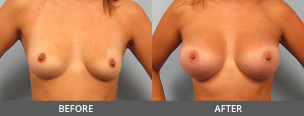 Before and After Breast Augmentation Naples, FL