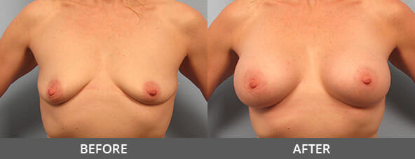 Before and After Breast Augmentation Naples, FL