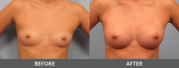 Before and After Breast Augmentation Naples, FL