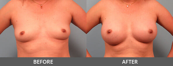 Before and After Breast Augmentation Naples, FL