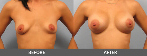 Before and After Breast Augmentation Naples, FL