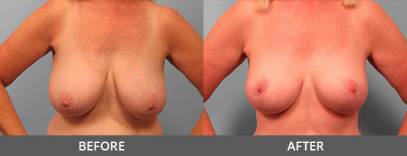 Before and After Breast Lift Naples, FL