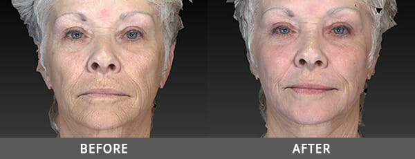 Before and After Laser Rejuvenation Naples, FL