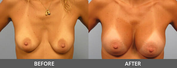 Before and After Breast Augmentation Naples, FL