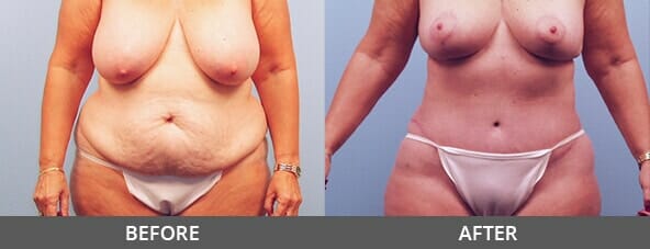 Tummy Tuck Before and After