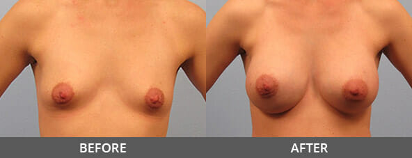 Before and After Breast Augmentation Naples, FL