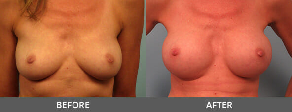 Before and After Breast Augmentation Naples, FL