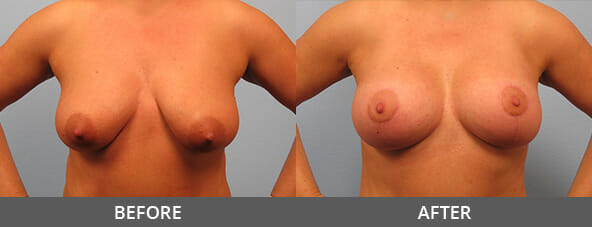 Before and After Breast Lift Naples, FL