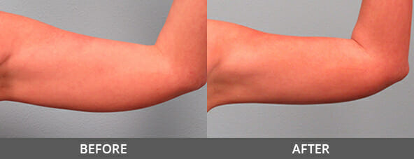 Before and After Arm Lift Naples, FL