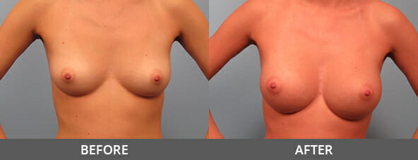 Before and After Breast Augmentation Naples, FL