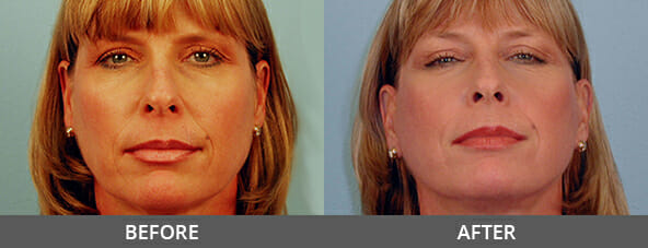 Facelift Before and After