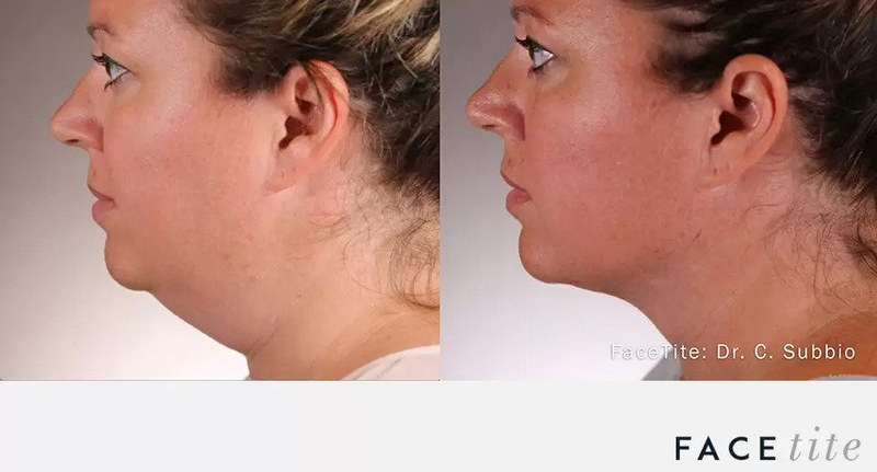 FaceTite results - Naples, FL Before and After FaceTite