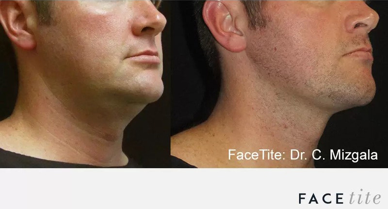 FaceTite results - Naples, FL Before and After FaceTite
